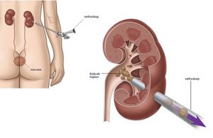 Böbrek taşı ameliyatı